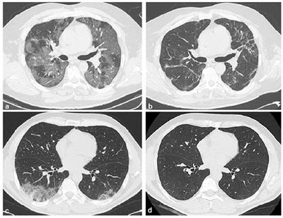 Characteristics and Prognostic Factors of Pulmonary Fibrosis After COVID-19 Pneumonia